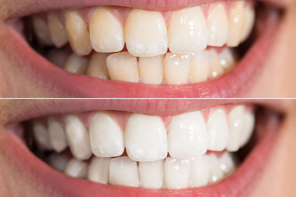 Long-lasting Teeth Whitening Treatments